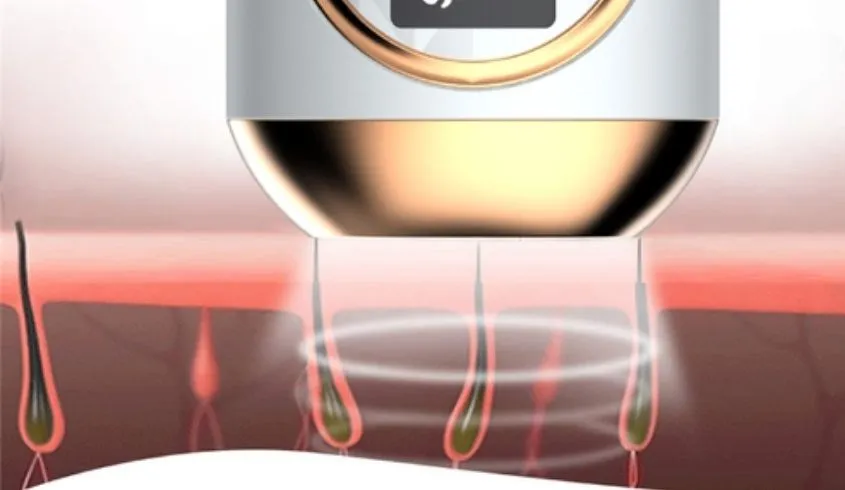 Hình ảnh mô tả cách ánh sáng IPL tác động vào nang lông, minh họa nguyên lý cách sử dụng máy triệt lông mini hiệu quả.