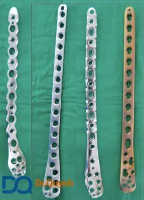 Minh họa các loại nẹp vít y tế chuyên dụng dùng trong cố định xương cẳng chân bị gãy.