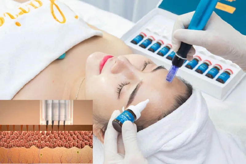 Tiến hành cấy tảo cho khách hàng bằng máy Dr Pen với kỹ thuật chuyên nghiệp