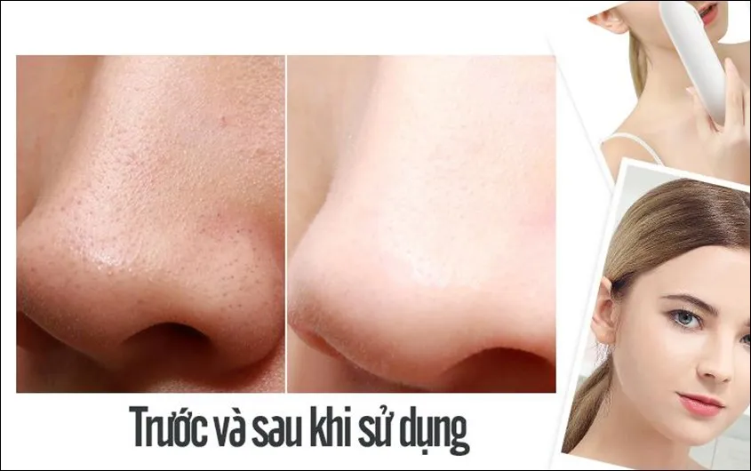 Kết quả làn da sạch mụn và sáng mịn sau khi áp dụng cách sử dụng máy hút mụn