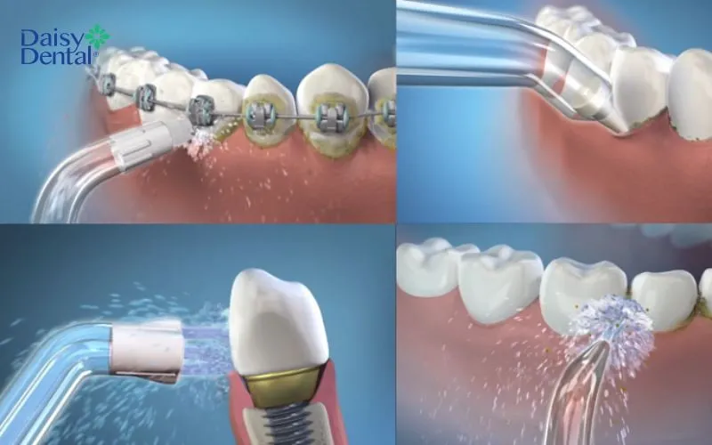 Làm sạch răng miệng cùng máy H2ofloss