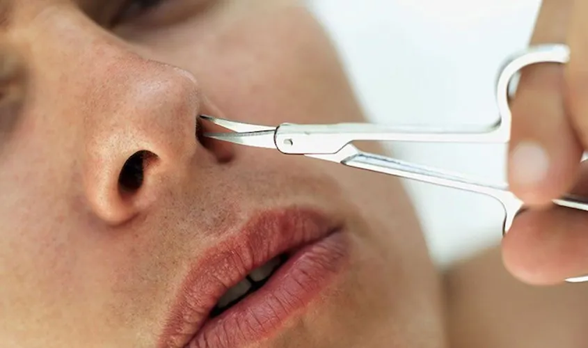 Lông mũi có thể gây mất thẩm mỹ