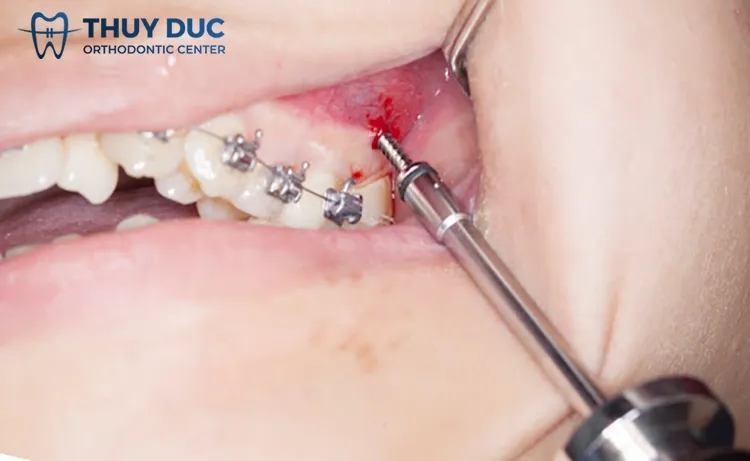 Cắm vít niềng răng bị sưng viêm khắc phục thế nào? 1