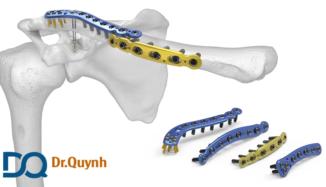 Chi phí mổ lấy nẹp vít xương đòn