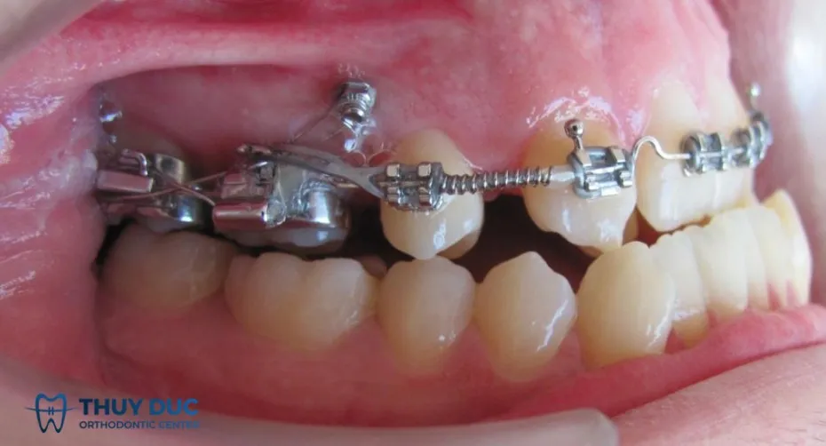 Cấu tạo và cơ chế hoạt động của minivis