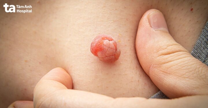 Làm Sao Để Mụn Tự Lắp Thịt: Hiểu Rõ Về Sự Hình Thành Và Phát Triển Của Mụn Thịt