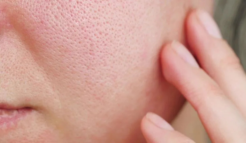 Lạm dụng máy hút mụn có thể dẫn đến tình trạng lỗ chân lông to và tổn thương da