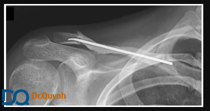 Mổ rút đinh hết bao nhiêu tiền