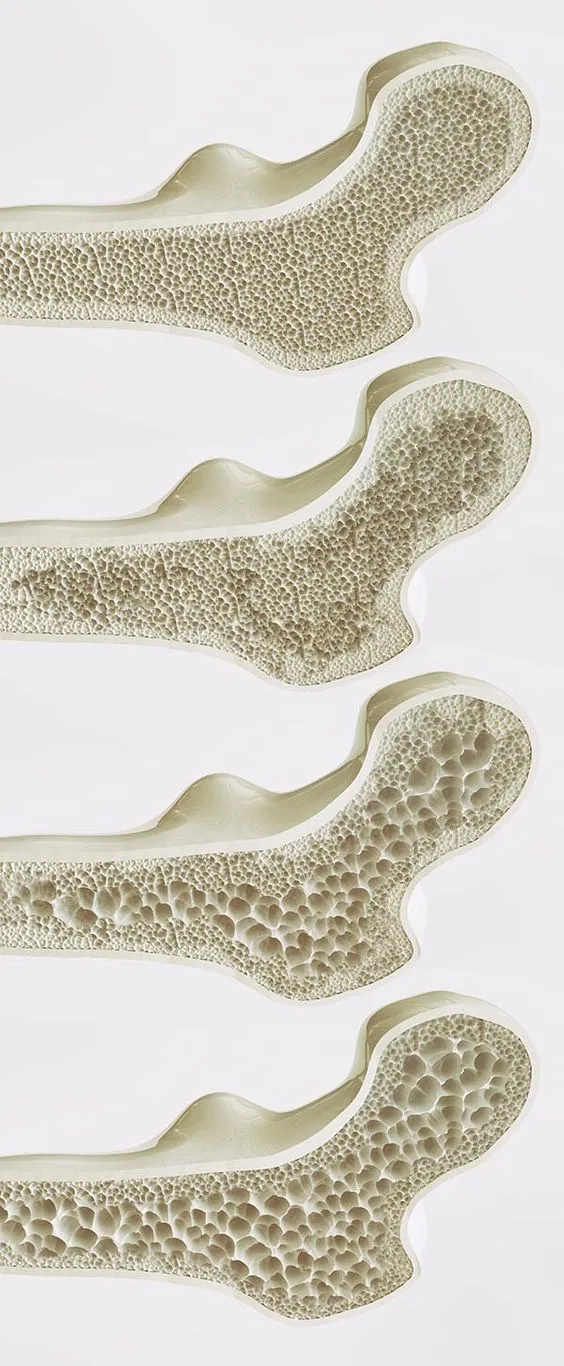 Biểu đồ minh họa các mức độ loãng xương giúp hiểu cách sử dụng máy đo loãng xương hiệu quả