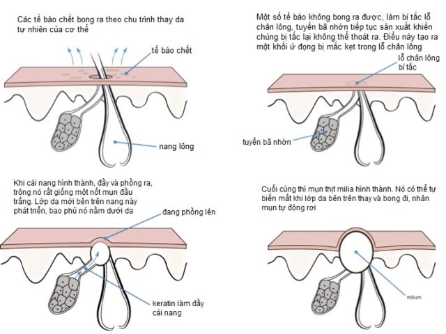 Làm Sao Để Mụn Tự Lắp Thịt: Hiểu Rõ Về Sự Hình Thành Và Phát Triển Của Mụn Thịt