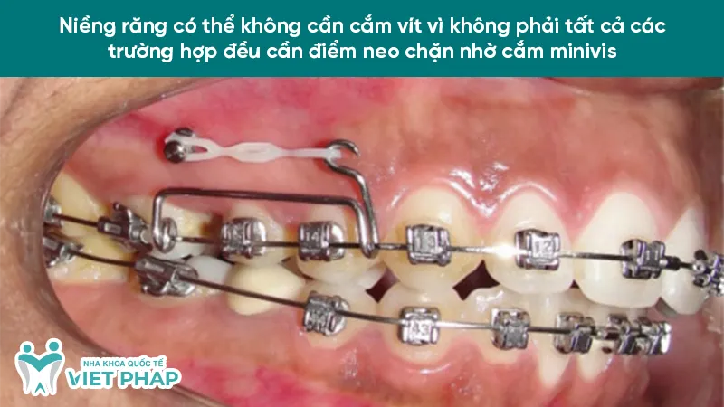 Phương pháp niềng răng không cắm vít áp dụng cho nhiều trường hợp sai lệch răng nhẹ