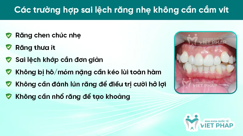 Hình ảnh minh họa răng chen chúc nhẹ có thể niềng răng không cắm vít