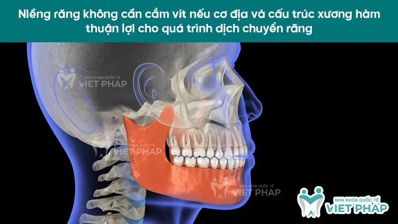 Cấu trúc xương hàm và cơ địa thuận lợi là yếu tố quan trọng để niềng răng không cắm vít