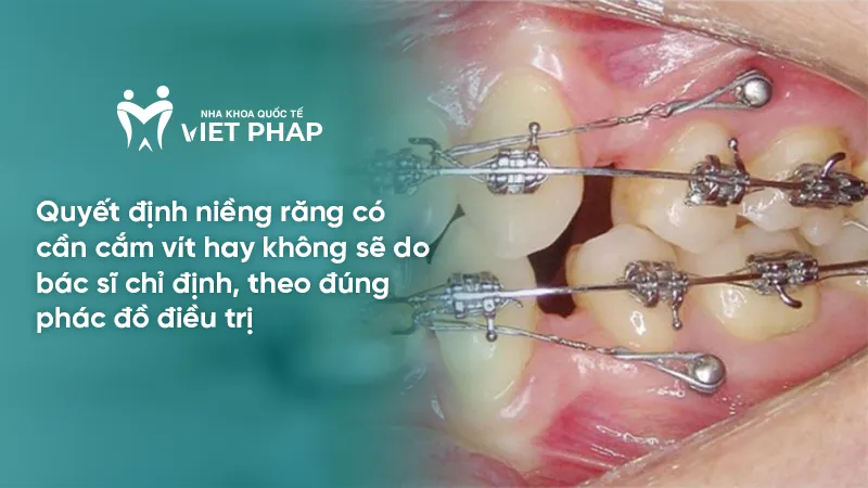 Bác sĩ chỉnh nha đưa ra phác đồ điều trị niềng răng không cắm vít dựa trên thăm khám kỹ lưỡng