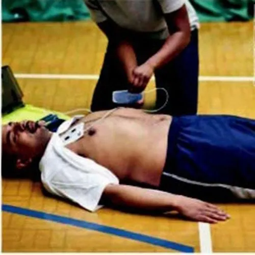 Đặt điện cực máy sốc điện tự động (AED) đúng vị trí trên ngực nạn nhân