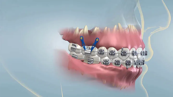 Hình ảnh thực tế mini vis chỉnh nha được đặt vào xương hàm khi niềng răng, minh họa lý do tại sao niềng răng phải bắt vít.