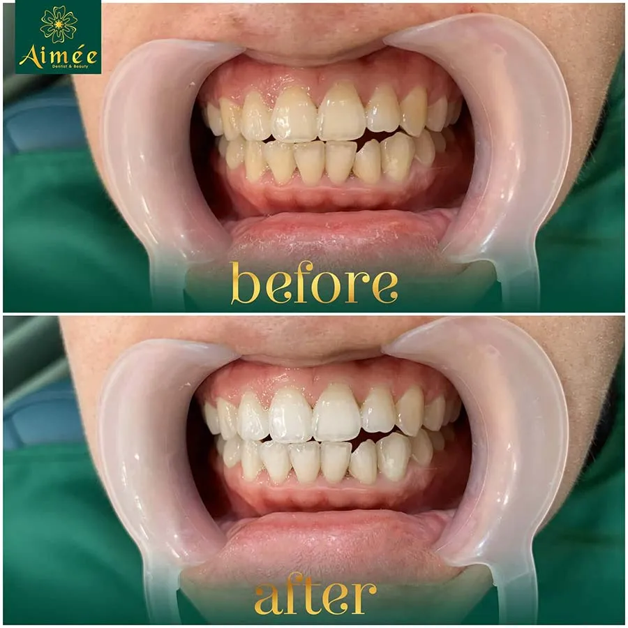 Nha sĩ hướng dẫn quy trình tẩy trắng răng chuyên nghiệp, đối sánh với cách sử dụng máy làm trắng răng tại nhà.