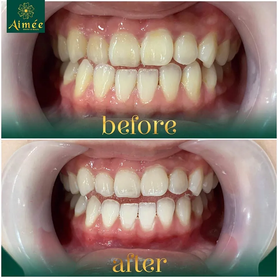 Tình trạng răng ố vàng trước khi áp dụng cách sử dụng máy làm trắng răng để cải thiện màu sắc.