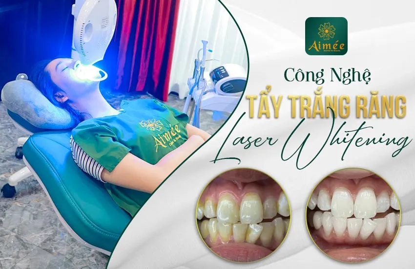 Công nghệ Laser Whitening tiên tiến trong nha khoa, một phương pháp hiệu quả hơn cách sử dụng máy làm trắng răng tại nhà.